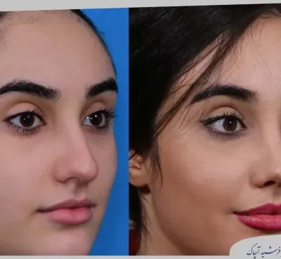 مقارنة قبل وبعد جراحة تجميل الأنف، صورة رقم 23 من معرض الدكتور فرشيد آچاك