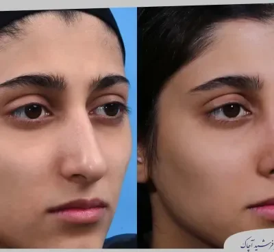 مقارنة قبل وبعد جراحة تجميل الأنف، صورة رقم 24 من معرض الدكتور فرشيد آچاك