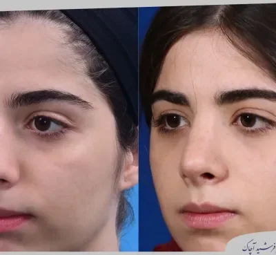 مقارنة قبل وبعد جراحة تجميل الأنف، صورة رقم 25 من معرض الدكتور فرشيد آچاك