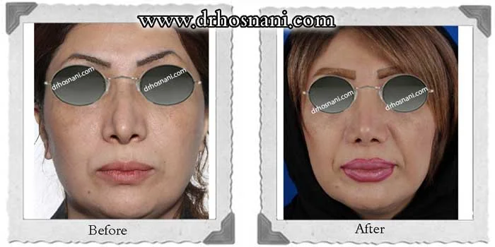 مقارنة قبل وبعد جراحة الأنف الترميمية، صورة رقم 281 من معرض الدكتور حميدرضا حسناني