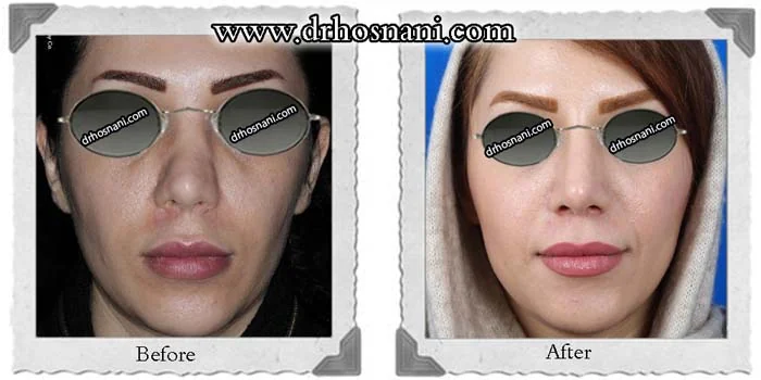 مقارنة قبل وبعد جراحة الأنف الترميمية، صورة رقم 293 من معرض الدكتور حميدرضا حسناني