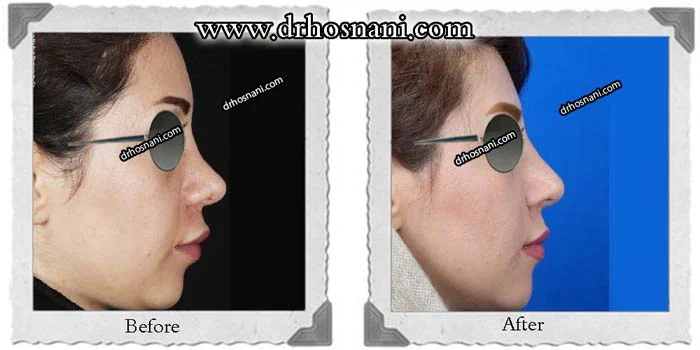 مقارنة قبل وبعد جراحة الأنف الترميمية، صورة رقم 294 من معرض الدكتور حميدرضا حسناني