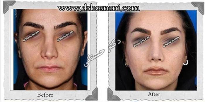 مقارنة قبل وبعد جراحة الأنف الترميمية، صورة رقم 425 من معرض الدكتور حميدرضا حسناني