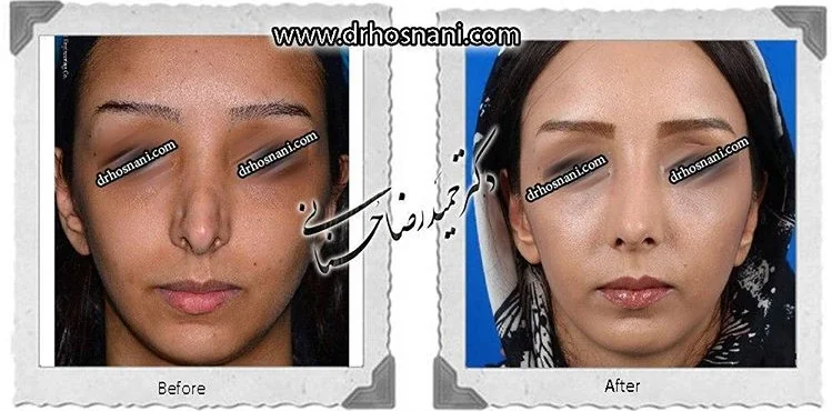 مقارنة قبل وبعد جراحة الأنف الترميمية، صورة رقم 459 من معرض الدكتور حميدرضا حسناني