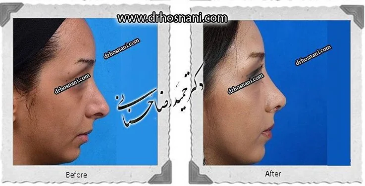 مقارنة قبل وبعد جراحة الأنف الترميمية، صورة رقم 460 من معرض الدكتور حميدرضا حسناني