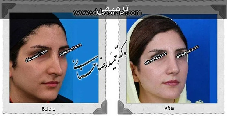 مقارنة قبل وبعد جراحة الأنف الترميمية، صورة رقم 464 من معرض الدكتور حميدرضا حسناني