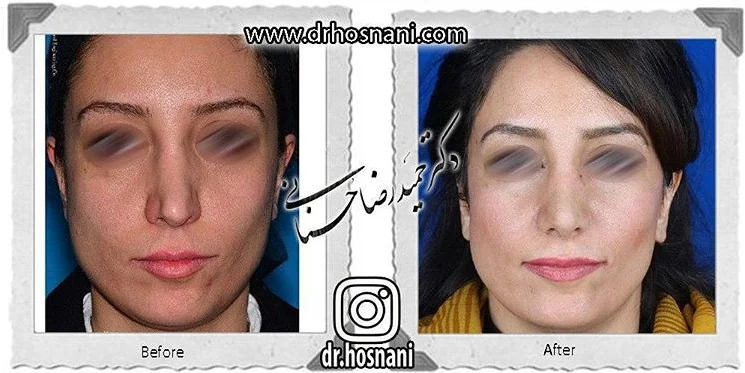 مقارنة قبل وبعد جراحة الأنف الترميمية، صورة رقم 624 من معرض الدكتور حميدرضا حسناني