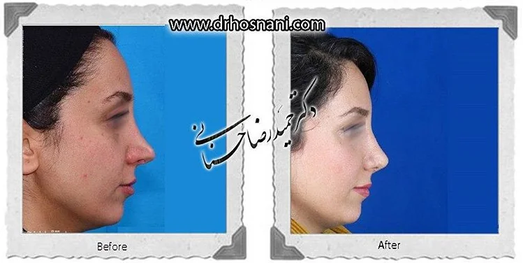 مقارنة قبل وبعد جراحة الأنف الترميمية، صورة رقم 625 من معرض الدكتور حميدرضا حسناني