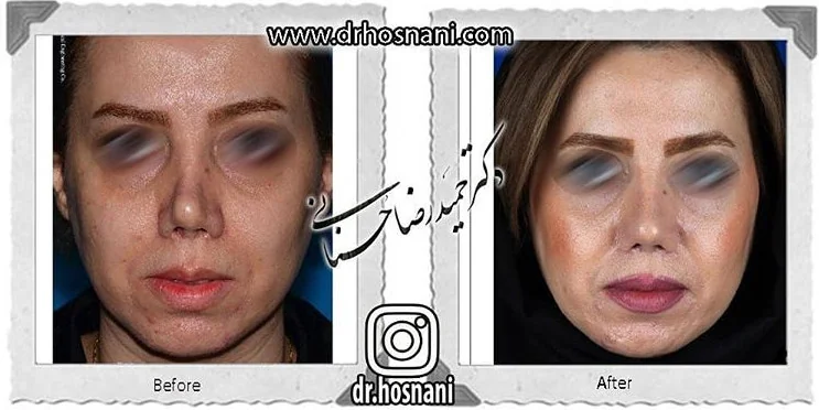 مقارنة قبل وبعد جراحة الأنف الترميمية، صورة رقم 692 من معرض الدكتور حميدرضا حسناني