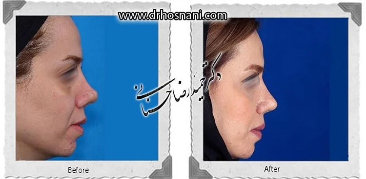 مقارنة قبل وبعد جراحة الأنف الترميمية، صورة رقم 693 من معرض الدكتور حميدرضا حسناني