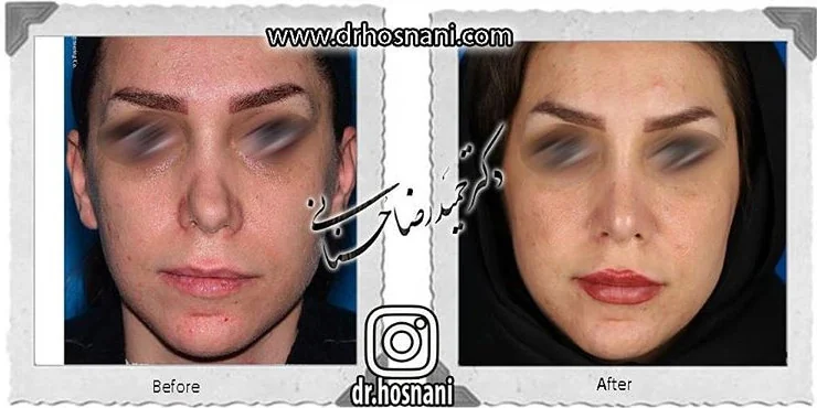 مقارنة قبل وبعد جراحة الأنف الترميمية، صورة رقم 696 من معرض الدكتور حميدرضا حسناني