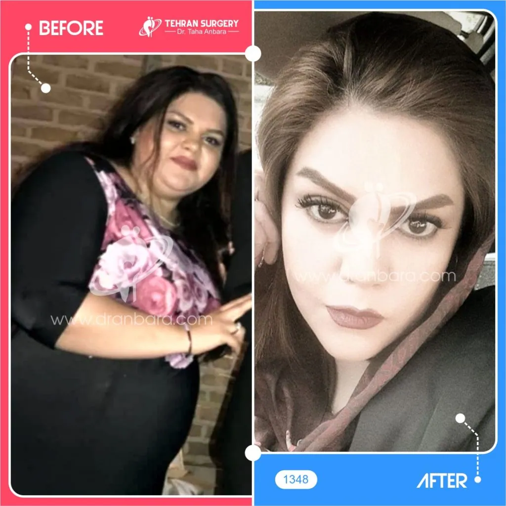 Provider-published weight-loss before and after example 13 from Dr Taha Anbara