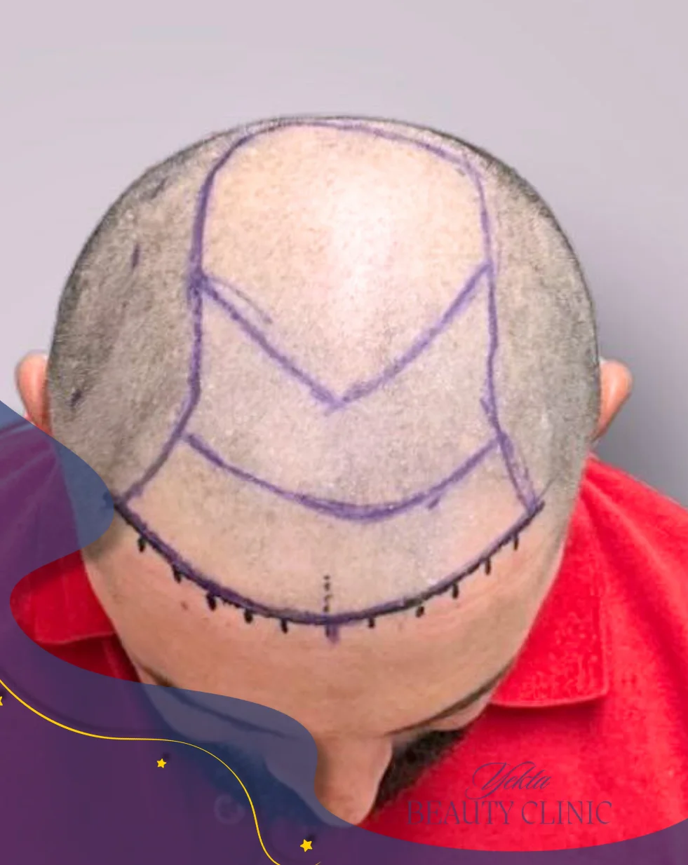 Scalp hair transplant before, case 1 published by Yekta Clinic — Piroozi