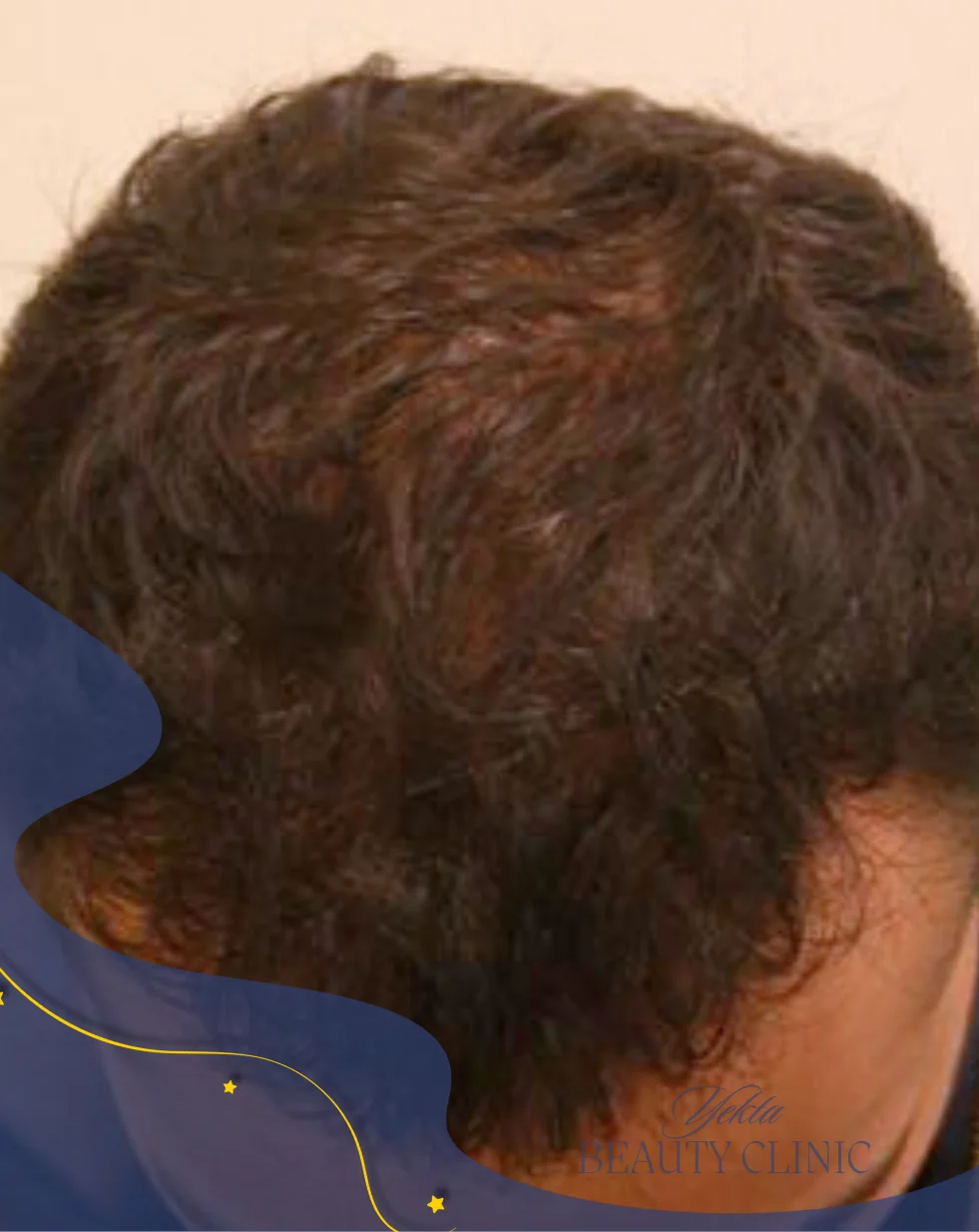 Scalp hair transplant after, case 5 published by Yekta Clinic — Piroozi