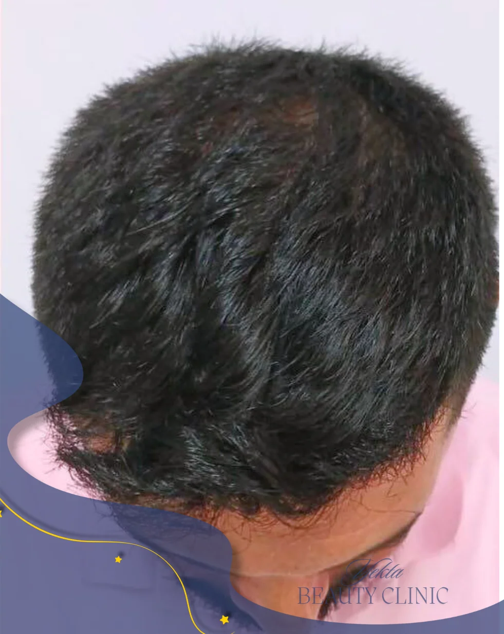 Scalp hair transplant after, case 1 published by Yekta Clinic — Piroozi