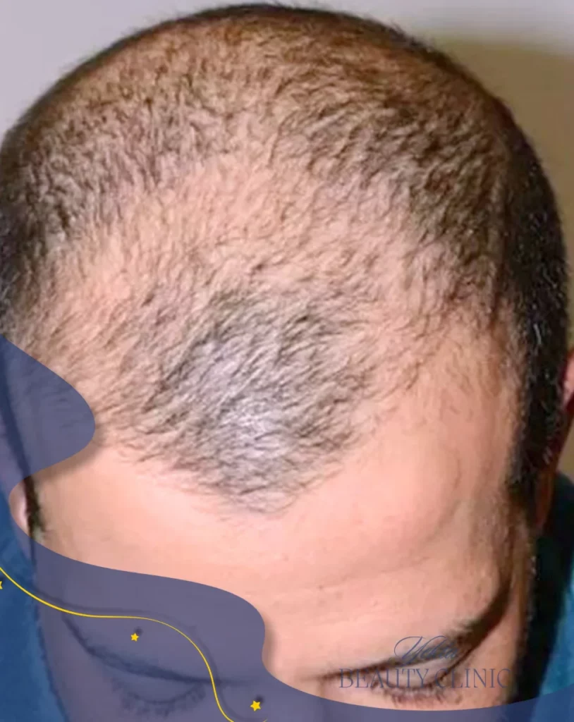 Scalp hair transplant before, case 2 published by Yekta Clinic — Piroozi