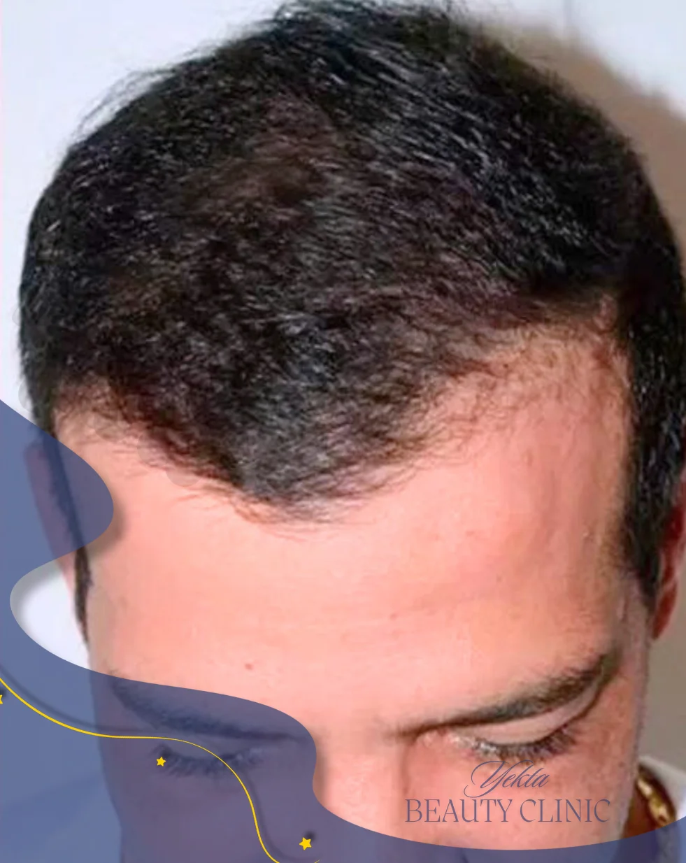 Scalp hair transplant after, case 2 published by Yekta Clinic — Piroozi