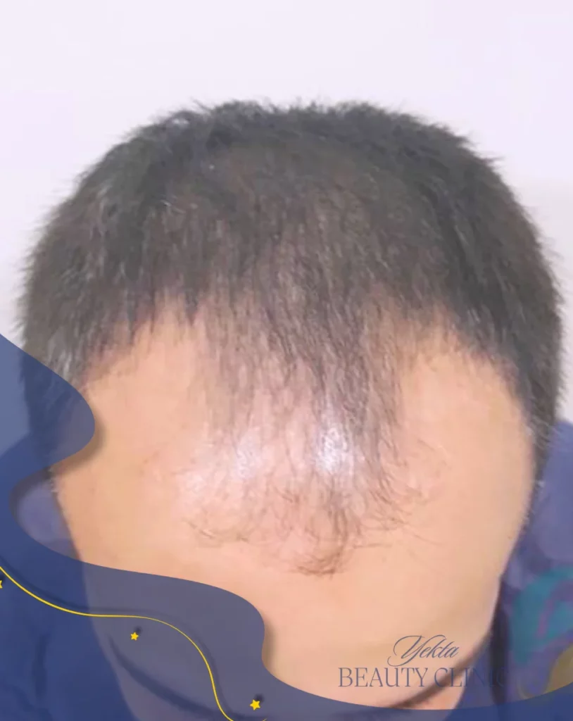 Scalp hair transplant before, case 3 published by Yekta Clinic — Piroozi