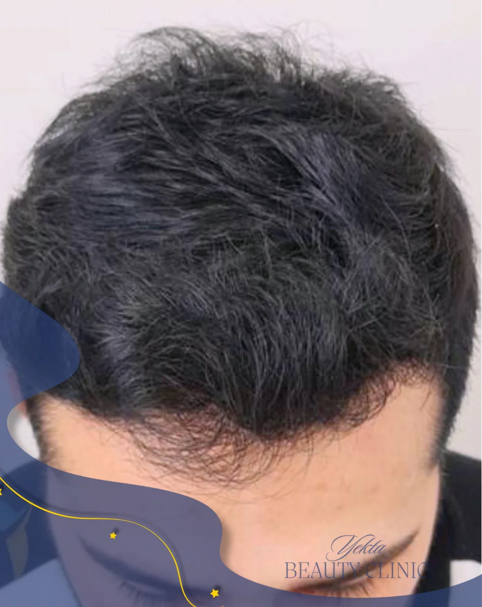 Scalp hair transplant after, case 3 published by Yekta Clinic — Piroozi