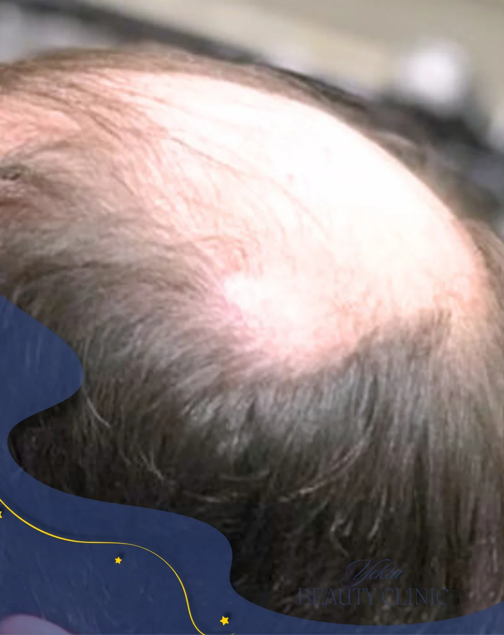 Scalp hair transplant before, case 4 published by Yekta Clinic — Piroozi