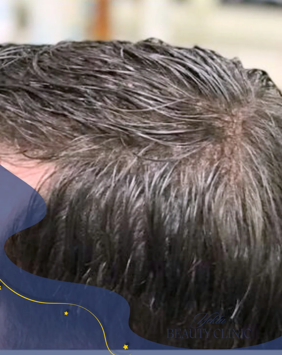 Scalp hair transplant after, case 4 published by Yekta Clinic — Piroozi