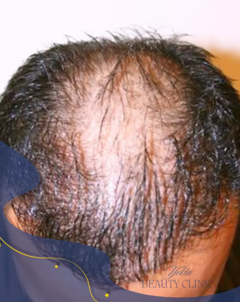 Scalp hair transplant before, case 5 published by Yekta Clinic — Piroozi