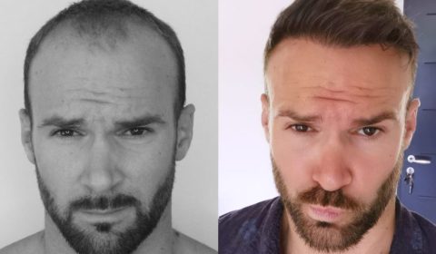 تكاليف زراعة الشعر ونصائح التخطيط المالي