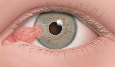علاج ظفرة العين في إيران: دليل شامل للعلاج الفعّال والتكاليف المعقولة