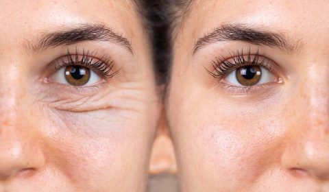 عملية تجميل الجفن السفلي بدون خياطة