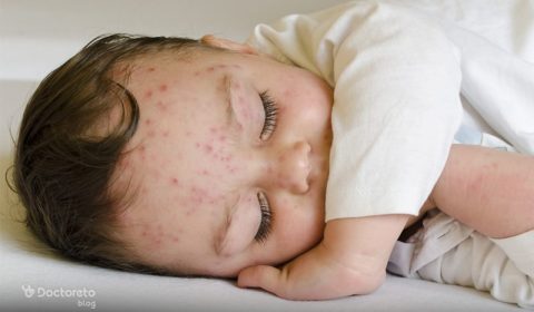 جدري الماء عند الأطفال: الأعراض، العلاج، والوقاية مع همينتور