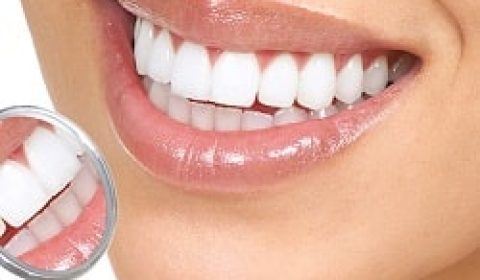 طب الأسنان التجميلي في إيران: ابتسامة هوليوود بأسعار معقولة مع همينتور