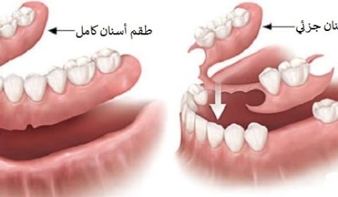 طقم الاسنان في ايران