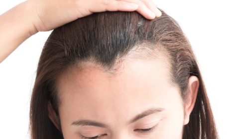 hairline-lowering-for-receding-hairline (1)