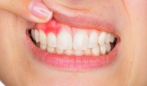 إنتان زرعة الأسنان: الأسباب والعلاجات