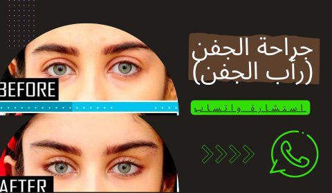 جراحة للجفن في إيران