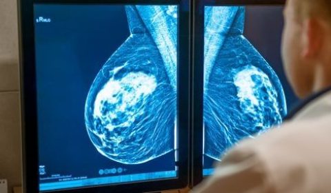 🎀 كثافة الثدي: تحديث الإرشادات والمقاربات الجديدة للكشف المبكر عن السرطان