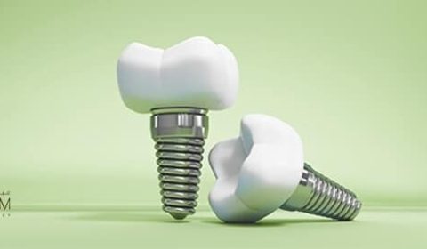 🦷 زراعة الأسنان: دليل شامل للعملية والتعافي والتكاليف