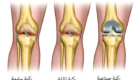 تعویض مفصل الركبة في إيران: دليل شامل 2025