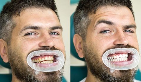ابتسامة مشرقة مع تبييض الأسنان في إيران مع همينتور