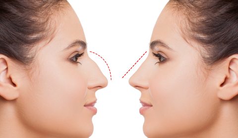 ترميم الأنف في إيران: استعادة الثقة بابتسامة مثالية