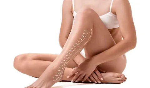 تقوس الساقين عند الكبار